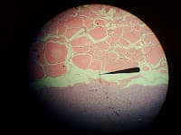 Entenda Melhor o Câncer de Tireóide