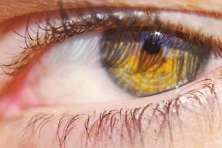 Brasileiro desenvolve diagnóstico da catarata pelo celular