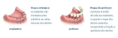 Vantagens dos Tratamentos com Implantes Dentários