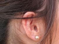 Acupuntura Auricular